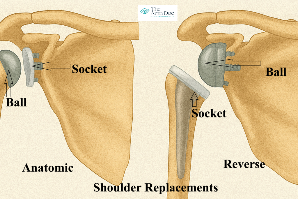 The ShoulDerdoc - REVERSE SHOULDER REPLACEMENT